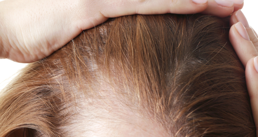 PRP for Hair Loss in Frisco, Texas